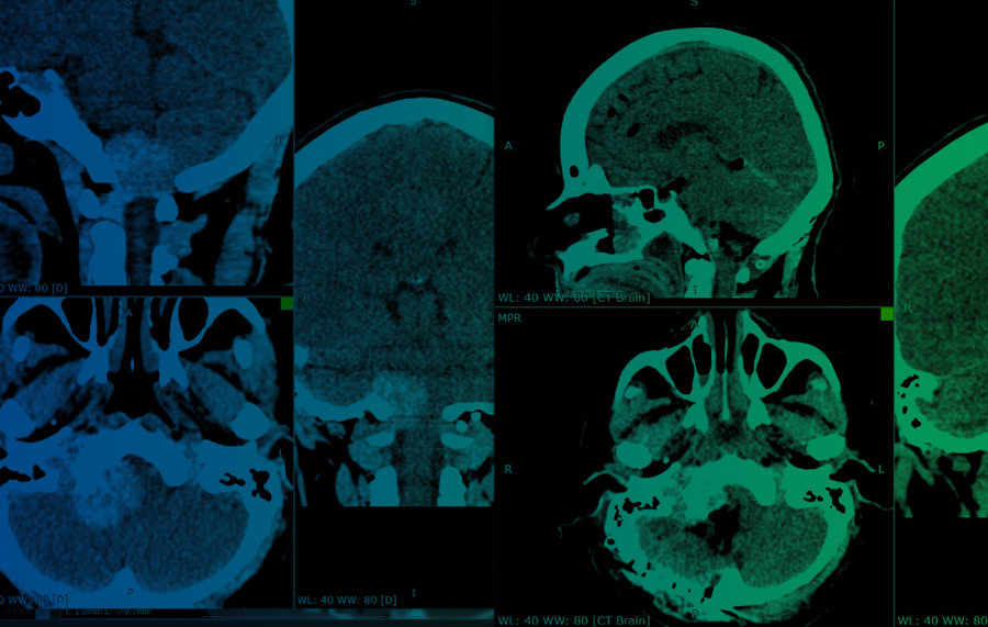 Exitoso tratamiento de meningioma de agujero magno en paciente con sintomas neurologicos severos - Hospital Clínica San Agustín