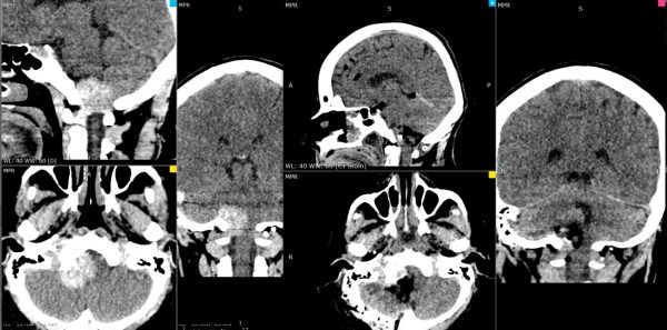 Exitoso tratamiento de meningioma de agujero magno en paciente con sintomas neurologicos severos - Hospital Clínica San Agustin